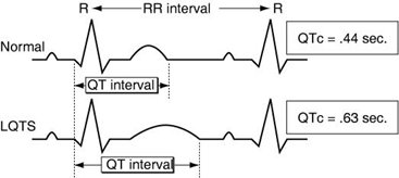 Long QT Syndrome