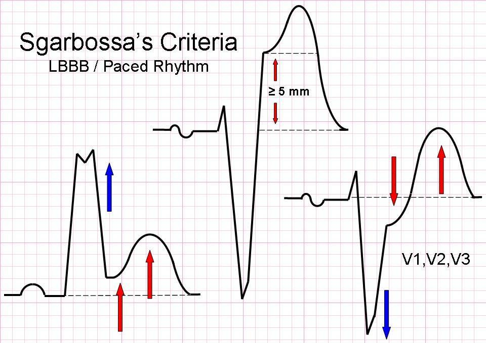 Sgarbossa Criteria