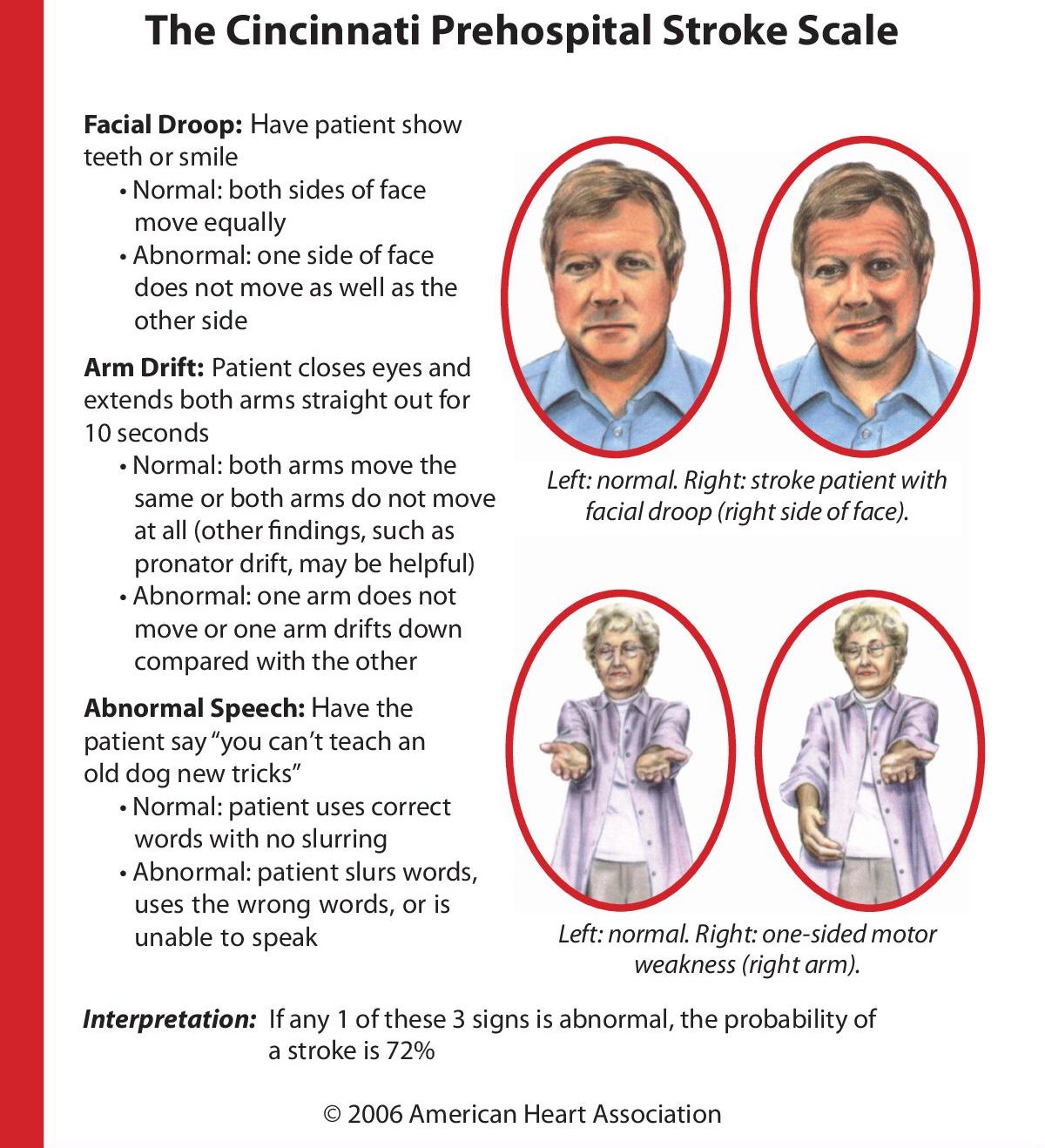 North Shore & Sea-to-Sky - Hot Stroke Clinical Pathway