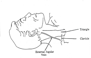 external jugular vein cannulation