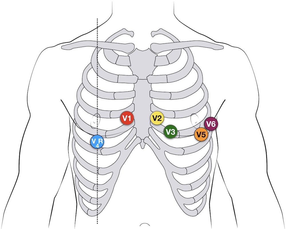 PR16: 12-Lead ECG Acquisition